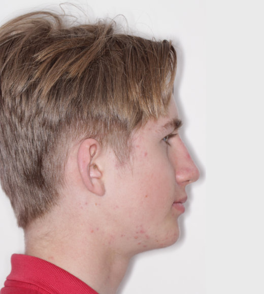 Side facial profile after twinblock