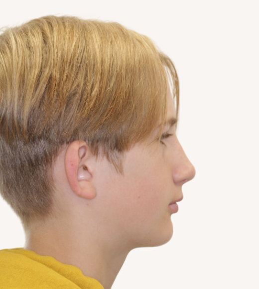 Side facial profile before twinblock