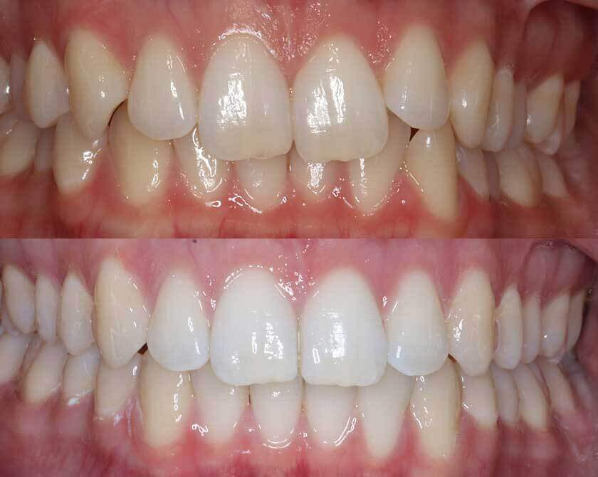 Invisalign-before-and-after-1