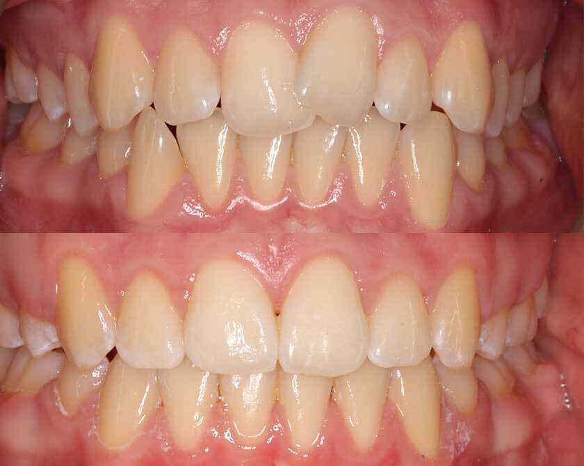 Invisalign-before-and-after-2