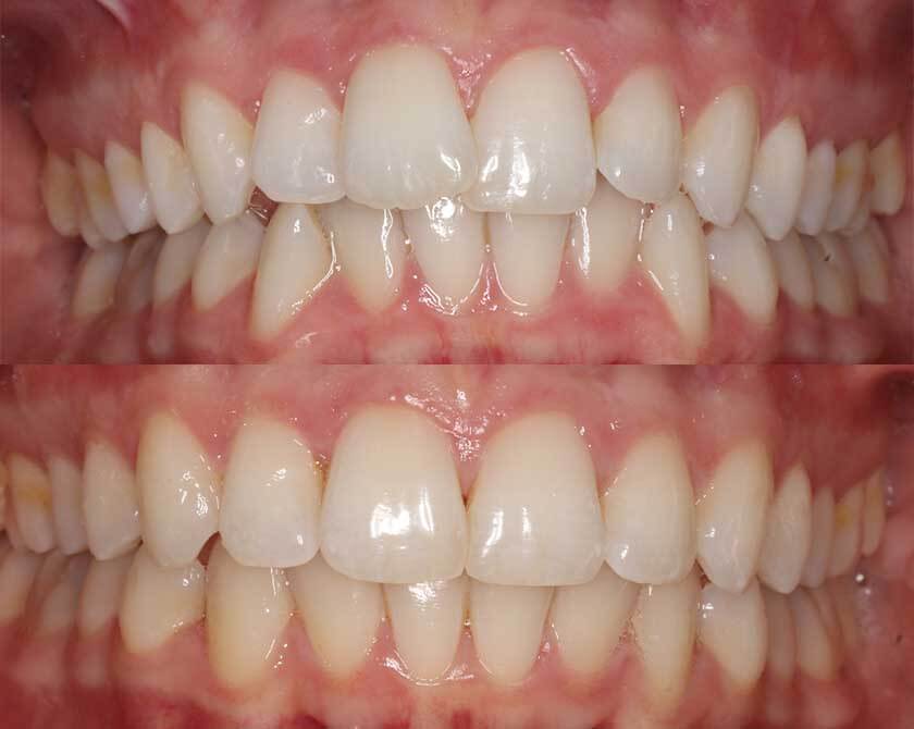 Invisalign-before-and-after-3