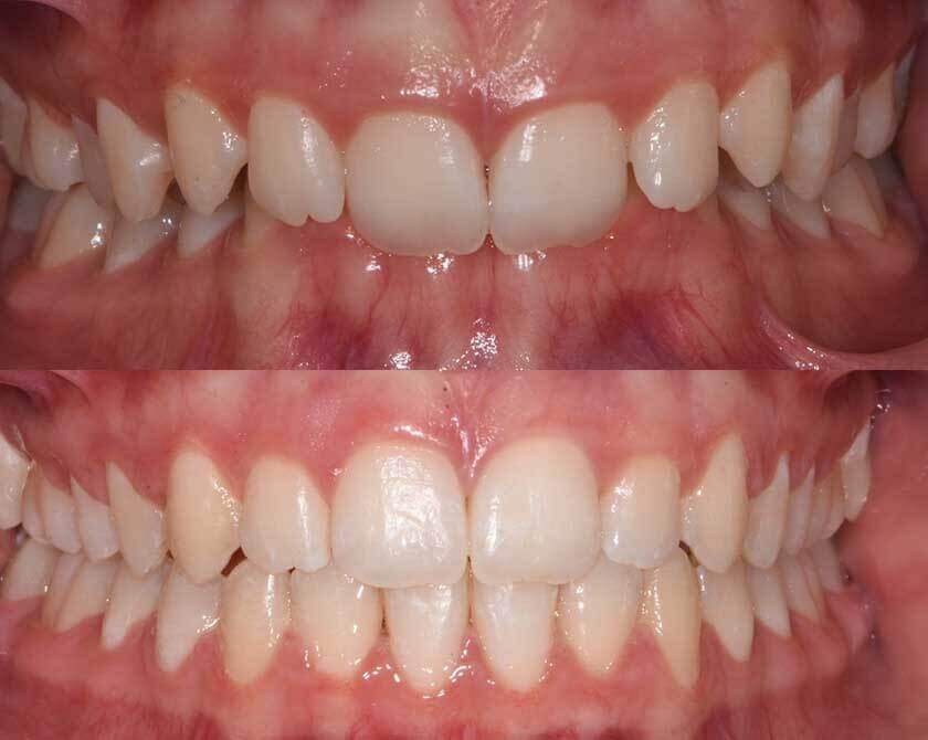ceramicbraces-before-and-after-1
