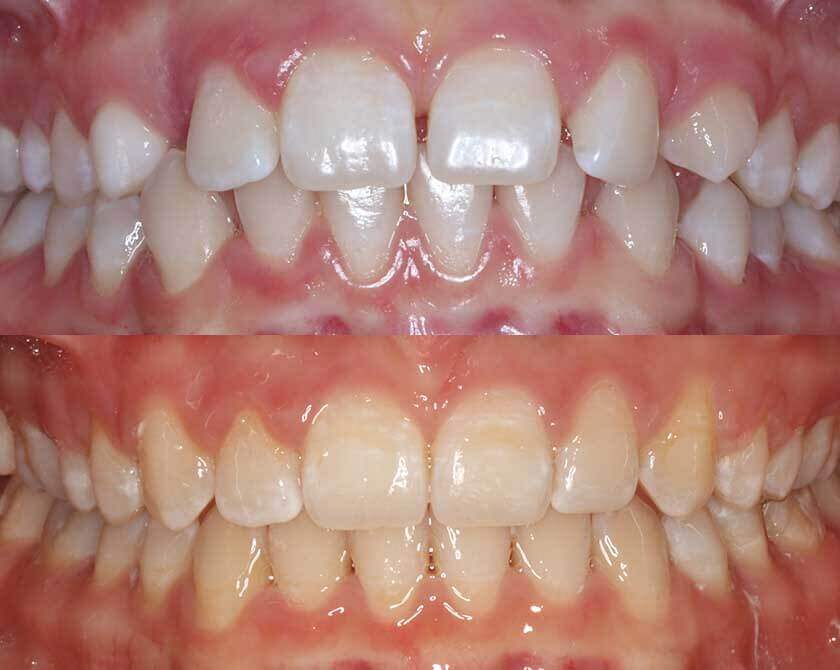 ceramicbraces-before-and-after-2