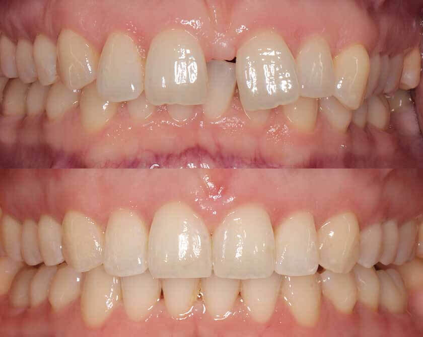 ceramicbraces-before-and-after-3