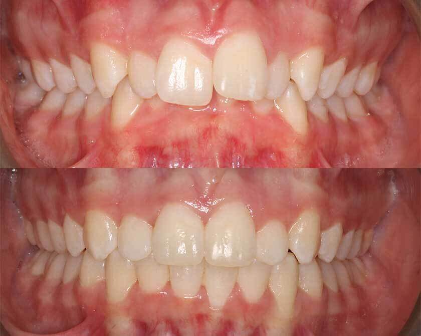 fixedbraces-before-and-after-1