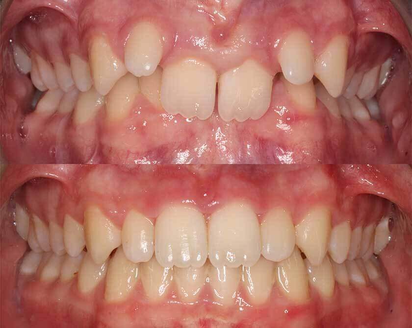 fixedbraces-before-and-after-2