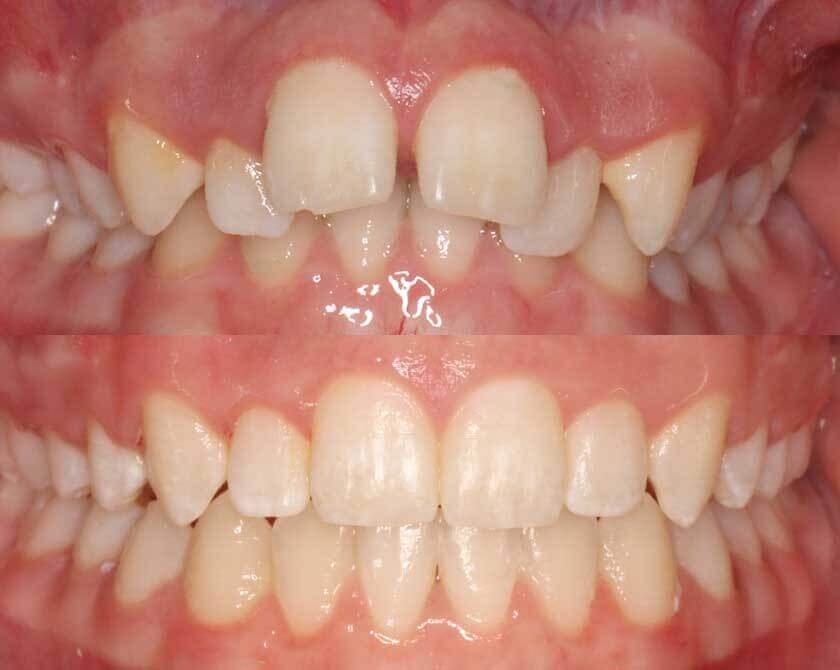 fixedbraces-before-and-after-3