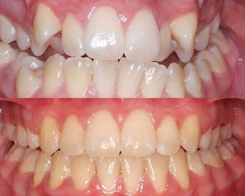 iconix-braces-before-and-after-1