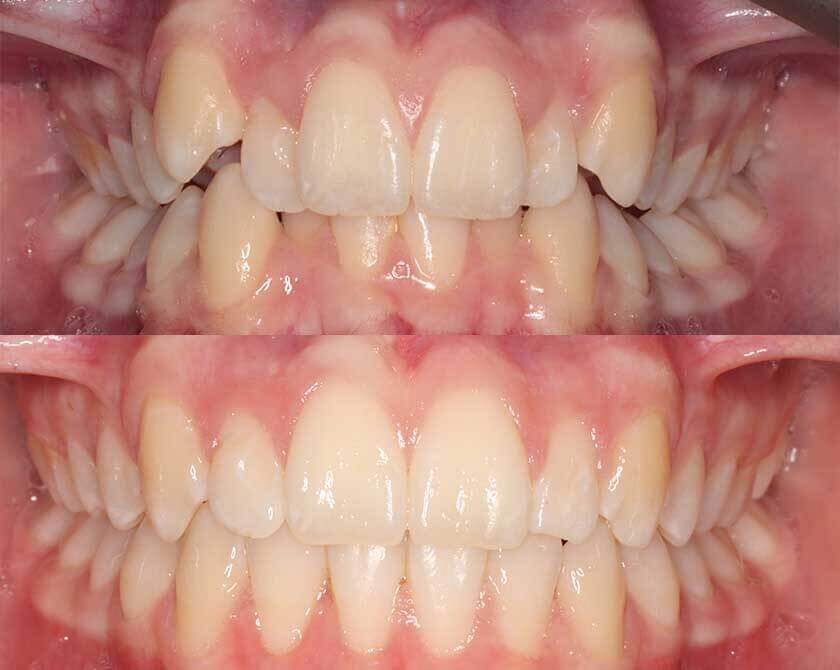 iconix-braces-before-and-after-2