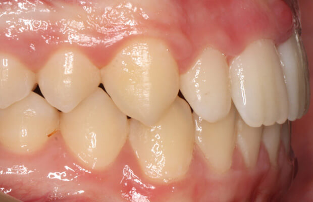 Twin block after - Case 2