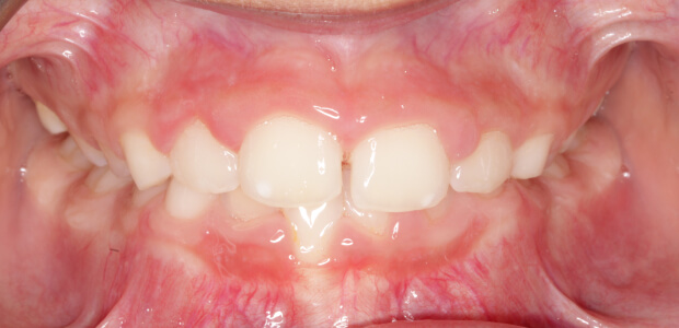 After early treatment