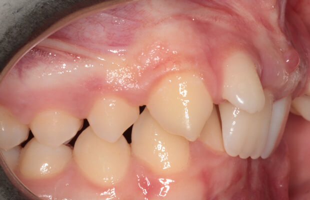 Twin block before - Case 2