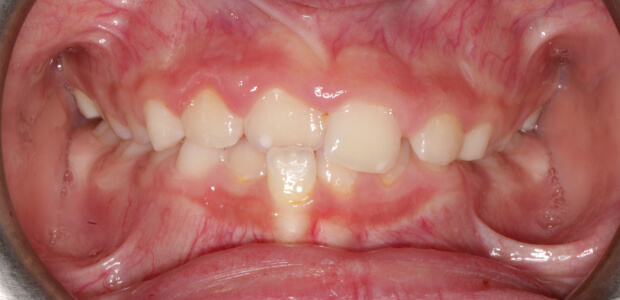 Before early treatment