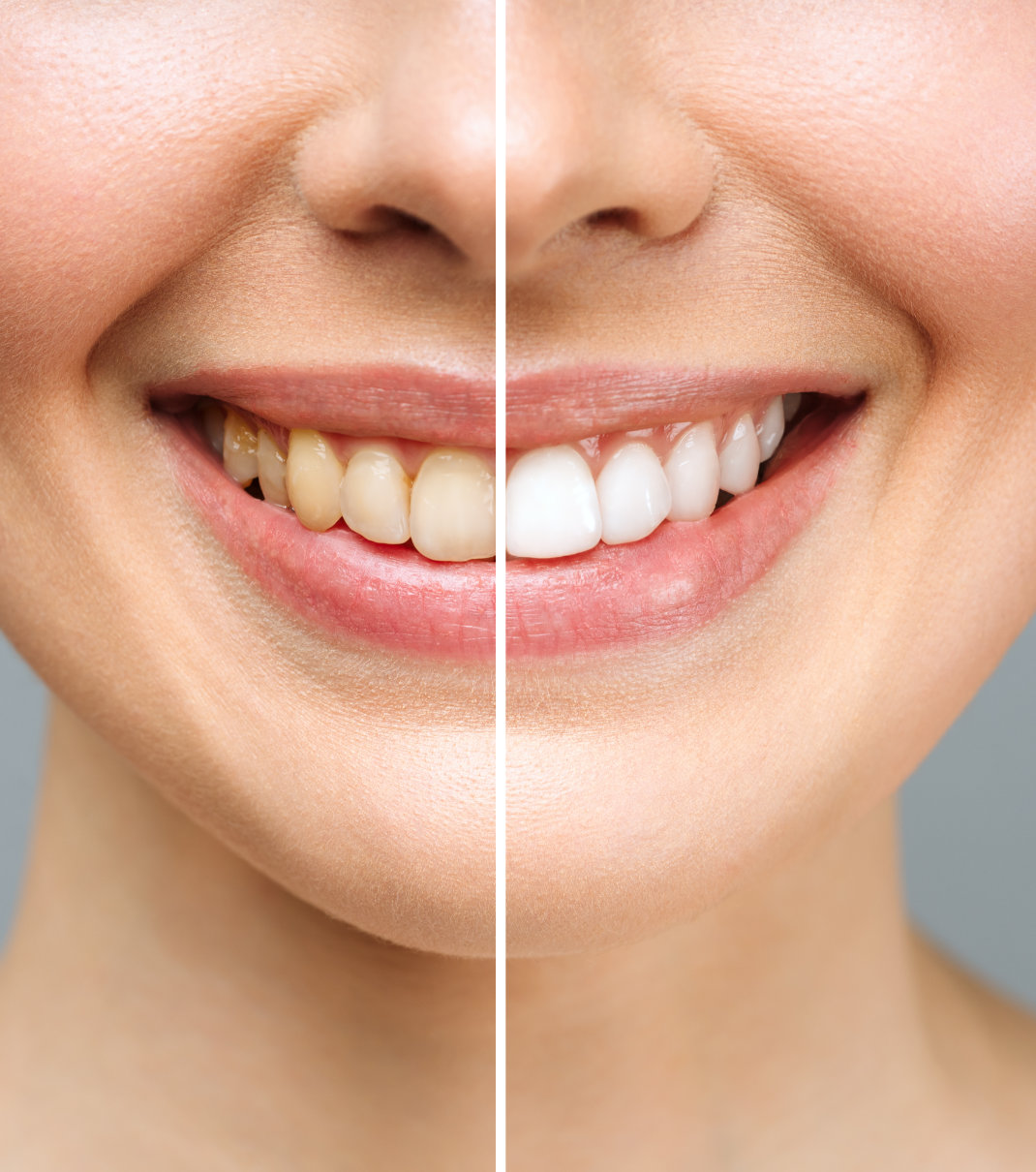 Dental hygienist consultation